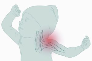 Illustration showing where the shoulder is affected in a baby with Erb's palsy.
