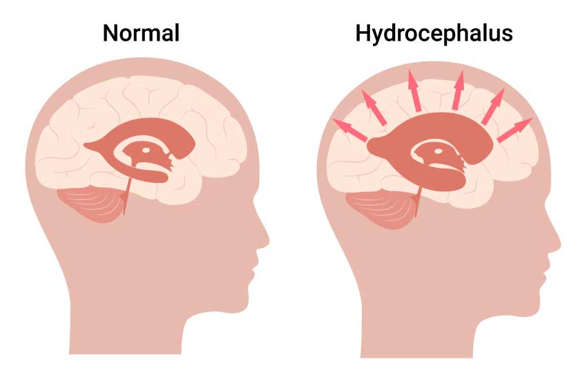 hydrocephalus in children